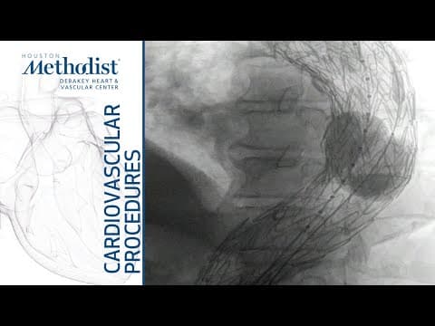 A Comprehensive Guide to TEVAR for Descending Thoracic Aneurysm