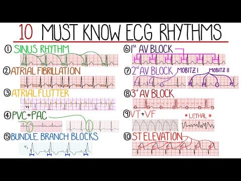 Understanding Common ECG Patterns: A Comprehensive Guide